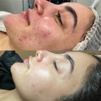 Blemish Control AHA 20%